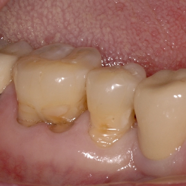 치경부 마모 임상사진