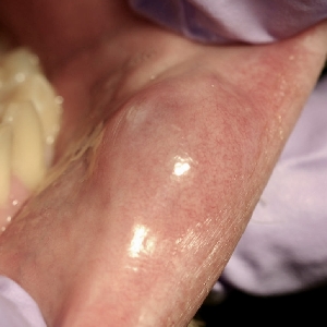 점액낭종 임상사진